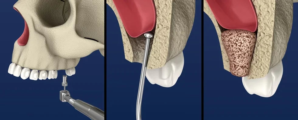 Understanding Sinus Lift Procedures for Dental Implants